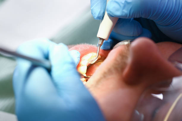 Best Emergency Wisdom Teeth Removal in Ste Genevieve, MO